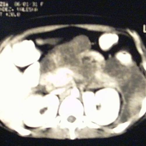 Lumbotomía en pancreatitis
