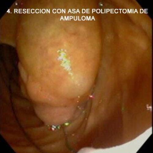 Ampuloma Duodenal