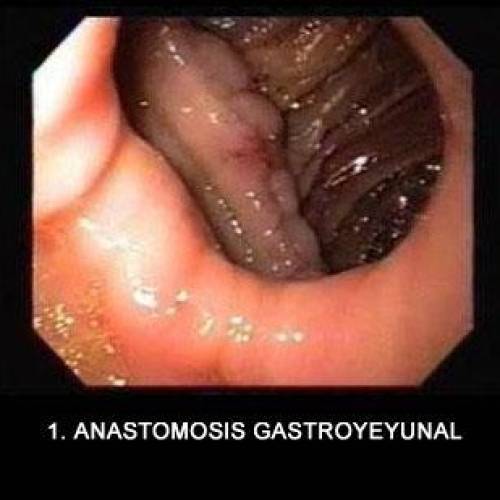 Anastomosis Gastroyeyunal