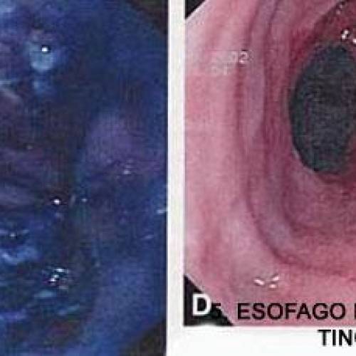 Esofago de Barret y Mucosectomia