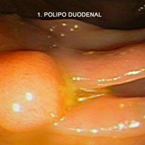 Polipo Duodenal