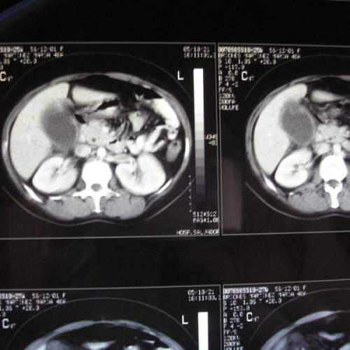 Cáncer de vesicula