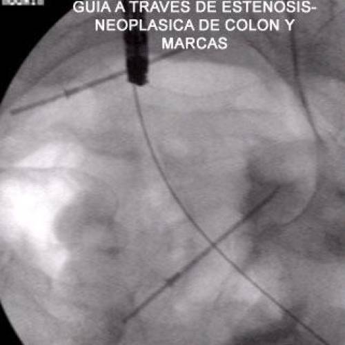 Protesis de Colon