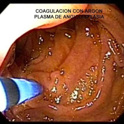 Enteroscopia