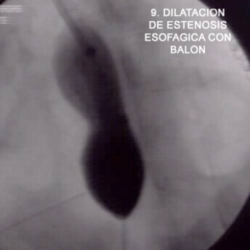 Dilatación Esofágica con Balón