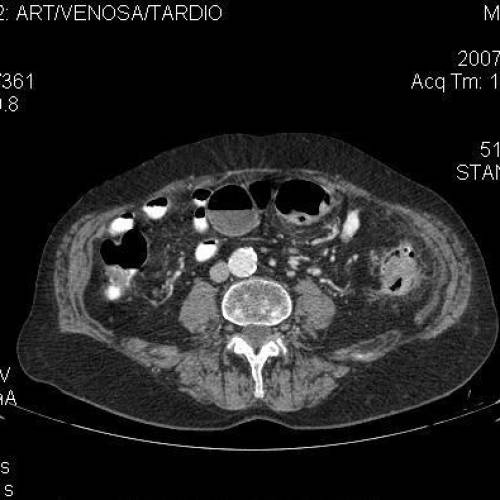 Diverticulitis 2