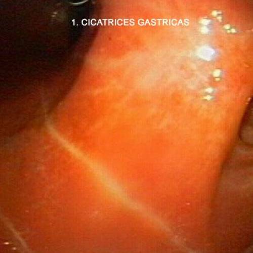 Cicatrices Gástricas