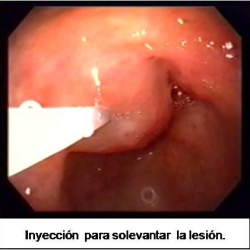 Mucosectomías Gástricas - Mucosectomía Lesión Intramucosa