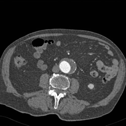 Aneurisma Aórta Abdominal