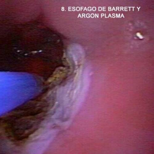 Esofago de Barret y Mucosectomia