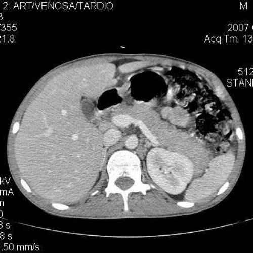 Pancreatitis VIH