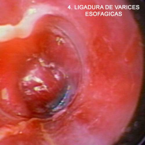Varices Esofágicas