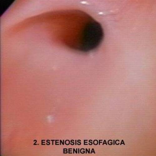 Estenosis Esofágica Benigna