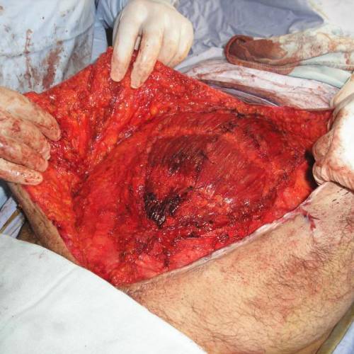 Reparación eventración por laparotomía contenida