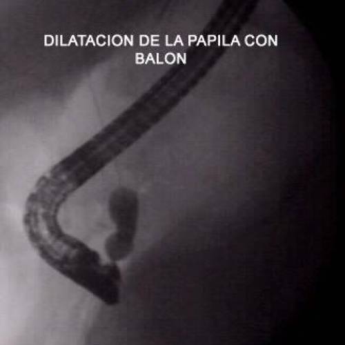 Papilotomia