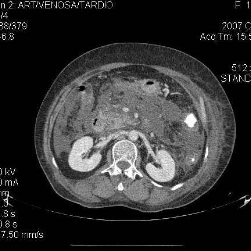 Pancreatits Necrotica