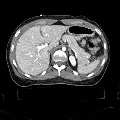 Laceración hepatica y  hemoperitoneo