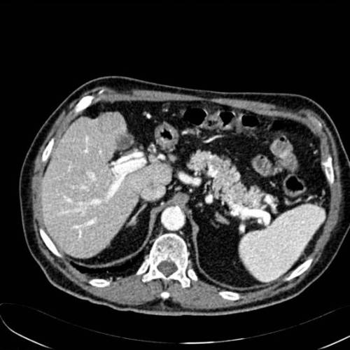 Hepatoma + hepatoma alcoholizado
