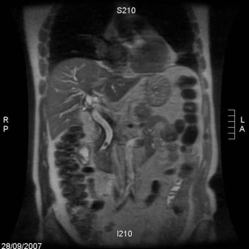 Coledocolitiasis