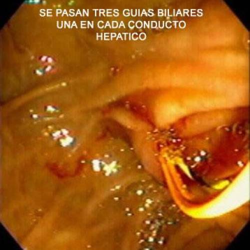 Estenosis maligna de Vía Biliar - Cancer de Vesicula