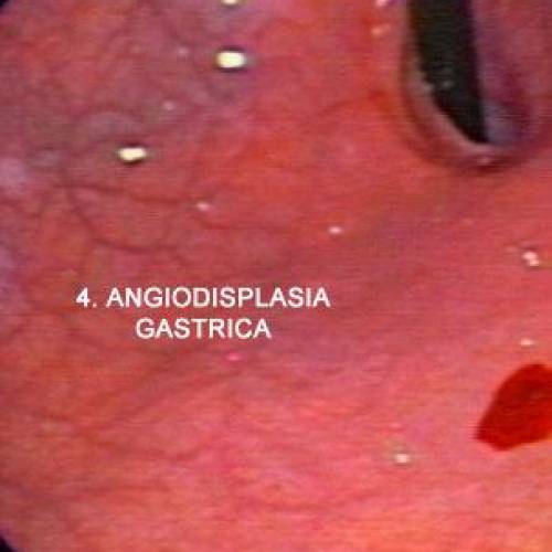 Angiodisplasia Gastrica
