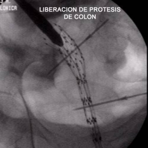 Protesis de Colon