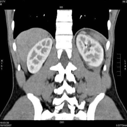 Fractura esplenica, laceración renal