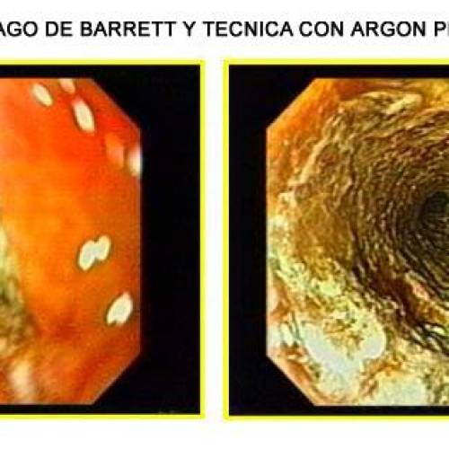 Esofago de Barret y Mucosectomia