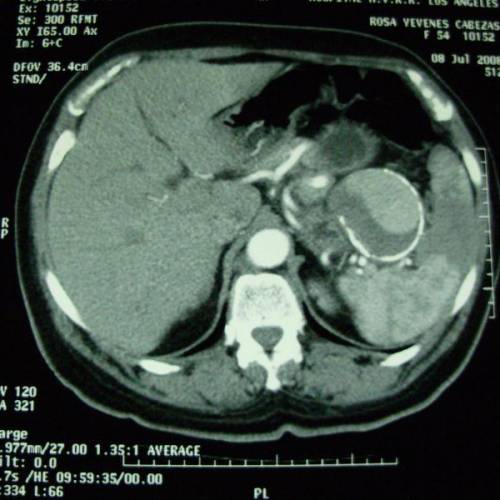 Tumor cola de páncreas