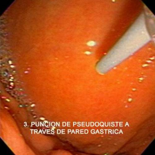 Pseudoquiste Páncreas