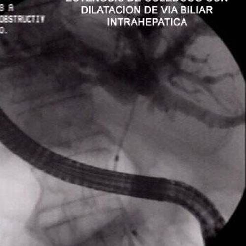 Estenosis Benigna de Via Biliar