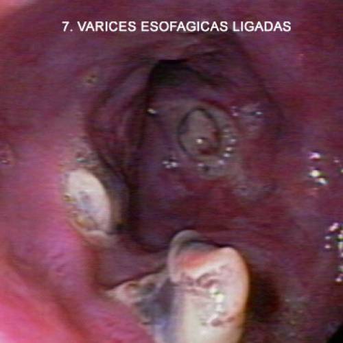 Varices Esofágicas