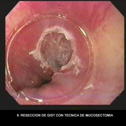 GIST Gástrico