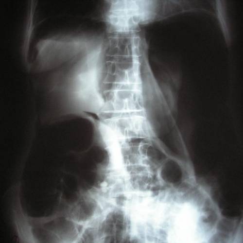 Perforación colon por colonoscopía