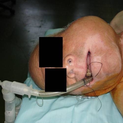 Tumor de parótida