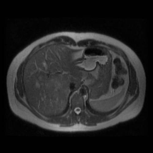 Hiperplasia Nodular Focal - RM