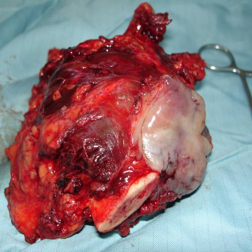 Tumor de parótida
