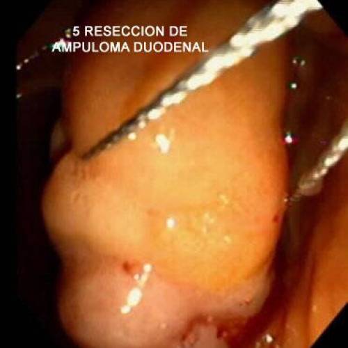 Ampuloma Duodenal