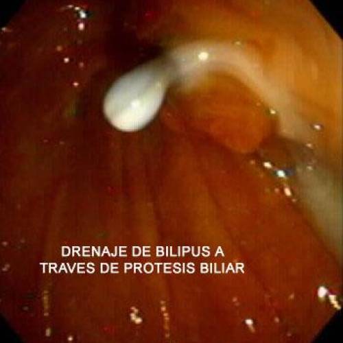 Estenosis maligna de Vía Biliar - Cancer de Pancreas