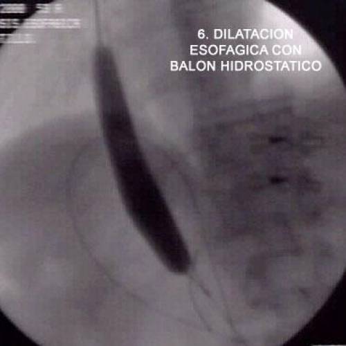 Divertículo de Zencker - Dilatación Esofágica con Balón