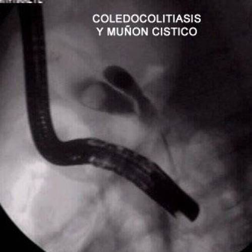 Coledocolitiasis