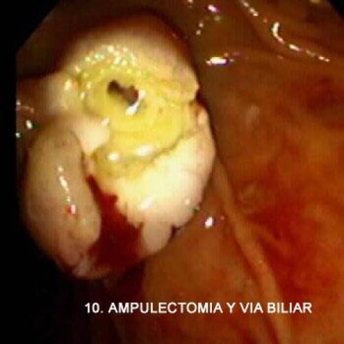 Ampuloma Duodenal