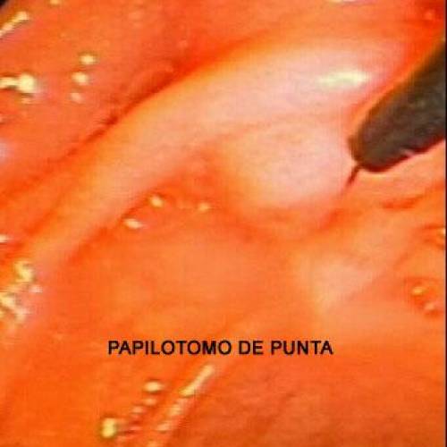 Precorte