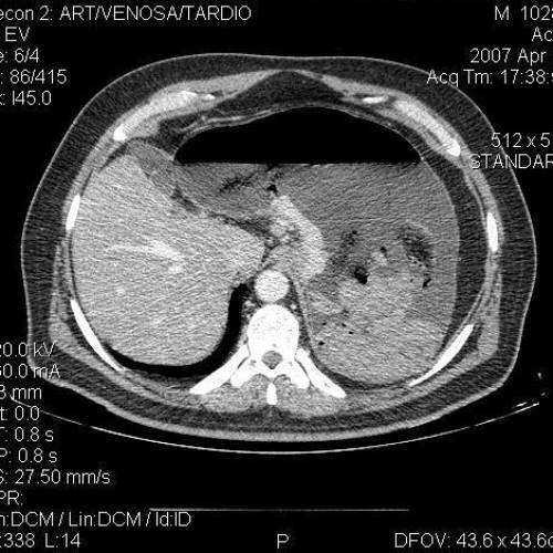 Ca Gastrico 2