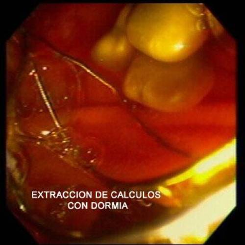 Coledocolitiasis