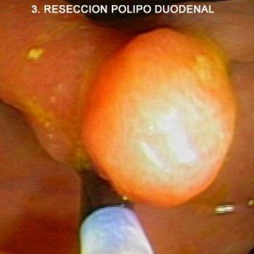 Polipo Duodenal