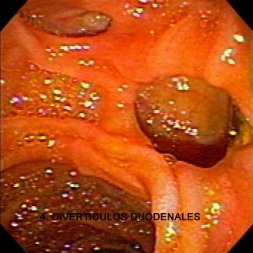Diverticulo Duodenal
