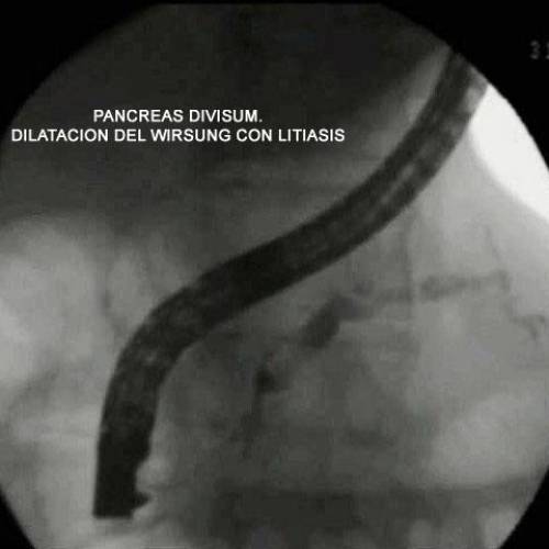 Pancreas Divisum