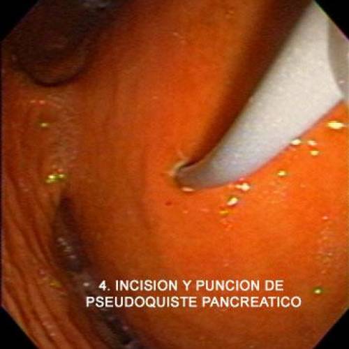 Pseudoquiste Páncreas
