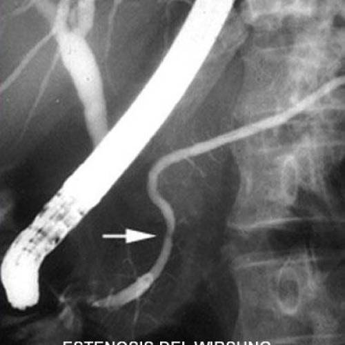 Estenosis del Wirsung